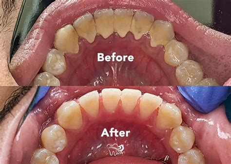This differs from your basic dental cleaning since the dentist or hygienist will need to remove tartar buildup underneath your gum tissue. . Deep cleaning teeth cost texas